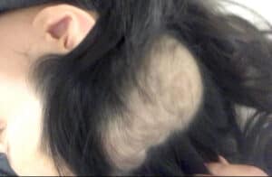 Hair Loss Treatment
