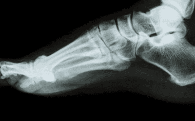 A Tiny Bone Growth of Painful Proportions