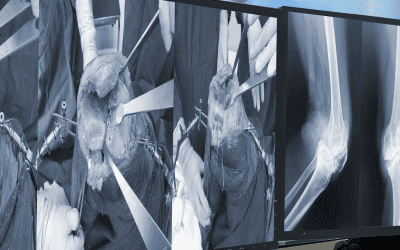 5 Things Wrong With Knee Replacement You Need To Know