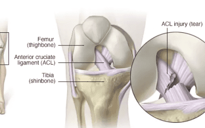 KNEE PAIN 1 – ACL TEARS