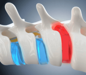 Herniated Disc Diagnosis 