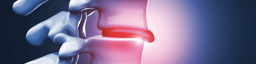 HERNIATED DISCS – A PAIN IN THE BACK