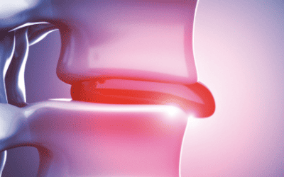 HERNIATED DISCS – A PAIN IN THE BACK